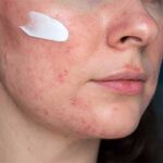 best moisturizers for rosacea