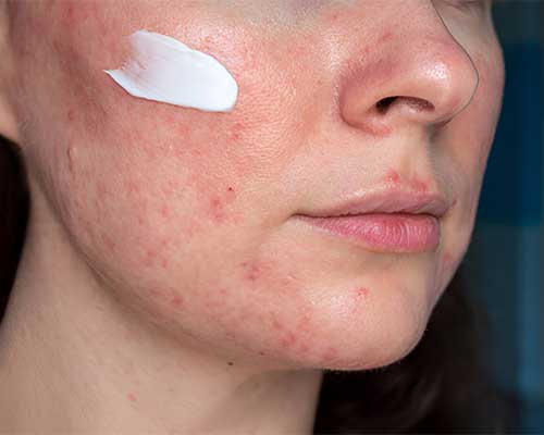 best moisturizers for rosacea